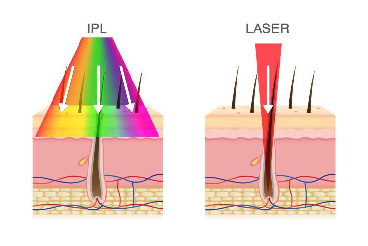 L'épilation au laser ou à la lumière pulsée