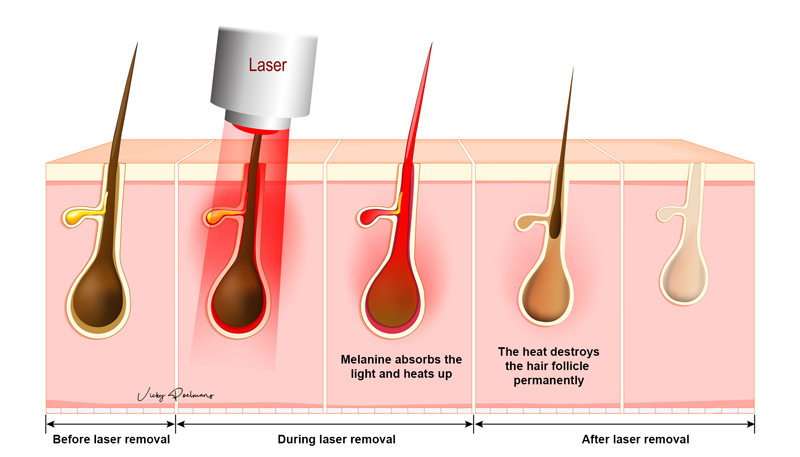 how does laser hair removal work